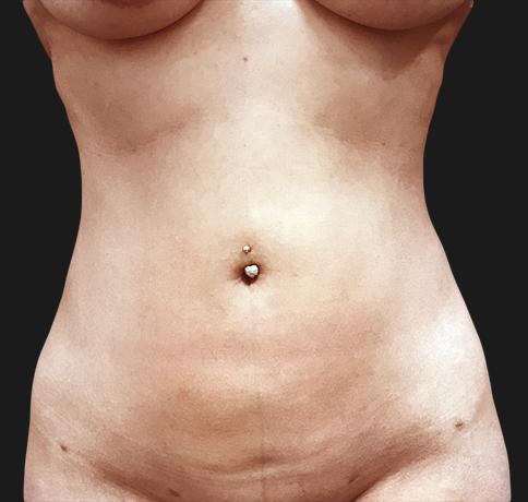 Liposuction after at Aristocrat Plastic Surgery in Scarsdale, NY