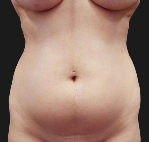 Liposuction before at Aristocrat Plastic Surgery in Scarsdale, NY