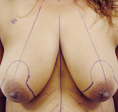 Breast Reduction before at Aristocrat Plastic Surgery in Scarsdale, NY