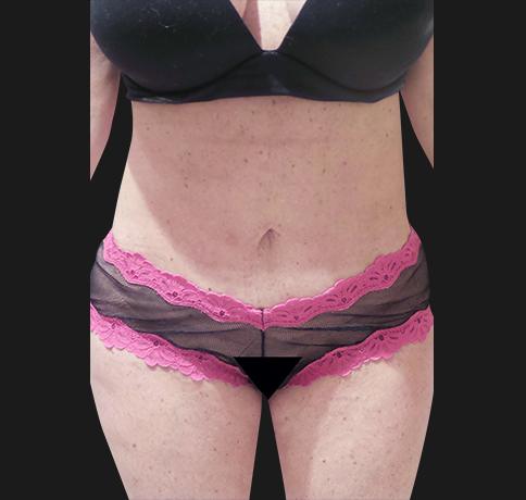 Tummy Tuck after at Aristocrat Plastic Surgery in Scarsdale, NY