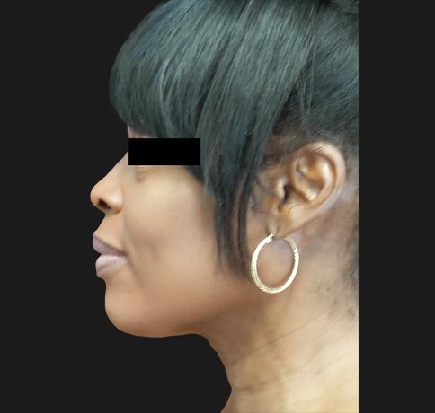 Neck Lift after at Aristocrat Plastic Surgery in Scarsdale, NY
