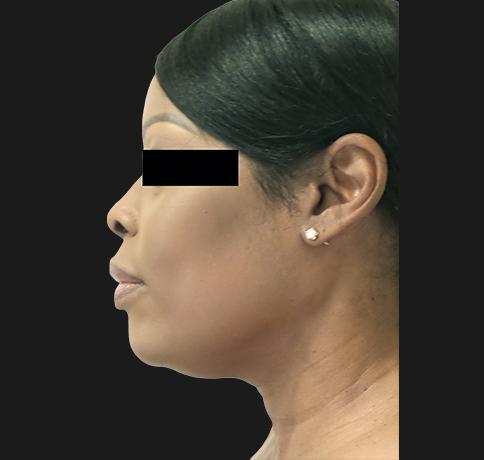 Neck Lift before at Aristocrat Plastic Surgery in Scarsdale, NY
