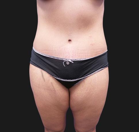Mommy Makeover after at Aristocrat Plastic Surgery in Scarsdale, NY