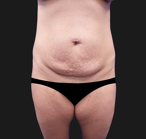 Mommy Makeover before at Aristocrat Plastic Surgery in Scarsdale, NY