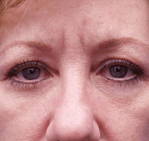 Blepharoplasty after at Aristocrat Plastic Surgery in Scarsdale, NY