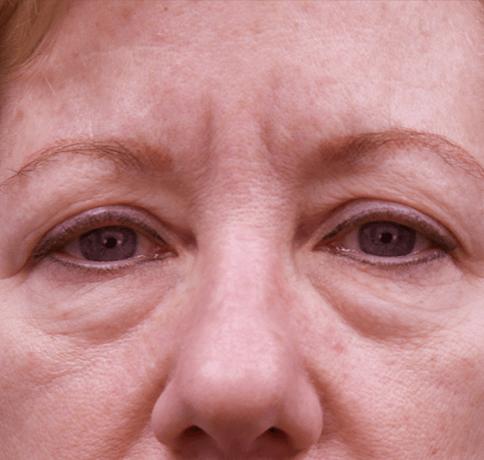 Blepharoplasty before at Aristocrat Plastic Surgery in Scarsdale, NY
