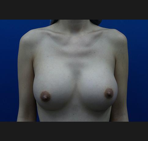 Breast Augmentation after at Aristocrat Plastic Surgery in Scarsdale, NY