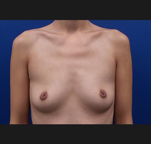 Breast Augmentation before at Aristocrat Plastic Surgery in Scarsdale, NY