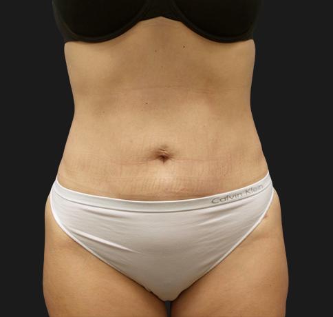 Liposuction after at Aristocrat Plastic Surgery in Scarsdale, NY