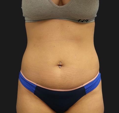 Liposuction before at Aristocrat Plastic Surgery in Scarsdale, NY