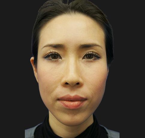 Blepharoplasty after at Aristocrat Plastic Surgery in Scarsdale, NY
