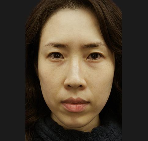 Blepharoplasty before at Aristocrat Plastic Surgery in Scarsdale, NY
