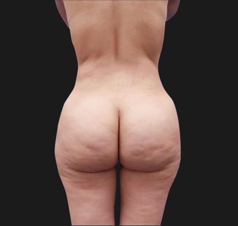 Aristocrat Plastic Surgery bbl after — Scarsdale, NY