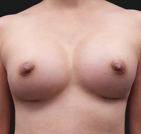 Aristocrat Plastic Surgery breast augmentation after — Scarsdale, NY