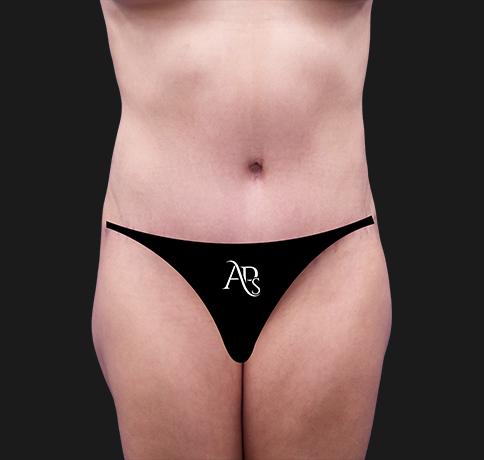 Aristocrat Plastic Surgery tummy tuck after — Scarsdale, NY