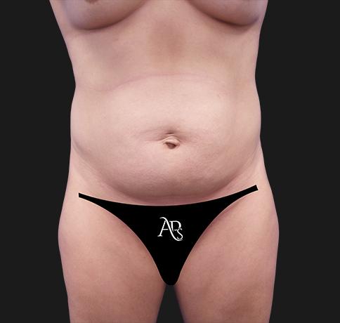 Tummy Tuck before at Aristocrat Plastic Surgery in Scarsdale, NY