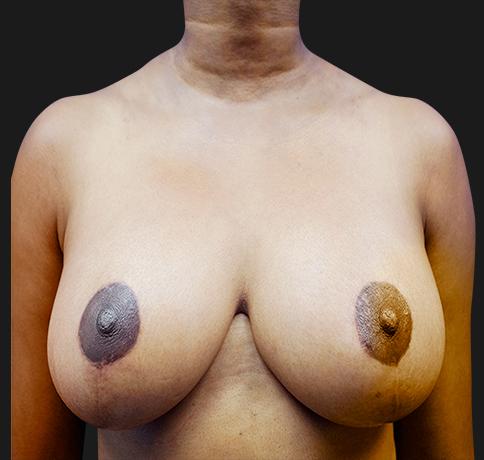 Breast Reduction after at Aristocrat Plastic Surgery in Scarsdale, NY