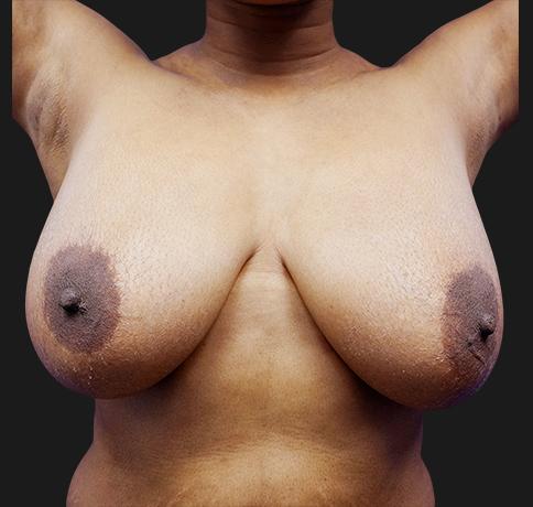 Breast Reduction before at Aristocrat Plastic Surgery in Scarsdale, NY