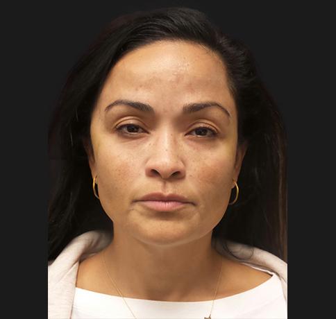 Facelift after at Aristocrat Plastic Surgery in Scarsdale, NY