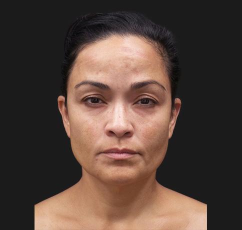 Facelift before at Aristocrat Plastic Surgery in Scarsdale, NY