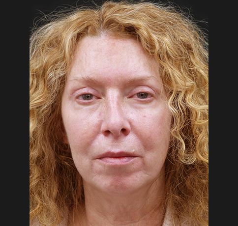 Blepharoplasty after at Aristocrat Plastic Surgery in Scarsdale, NY