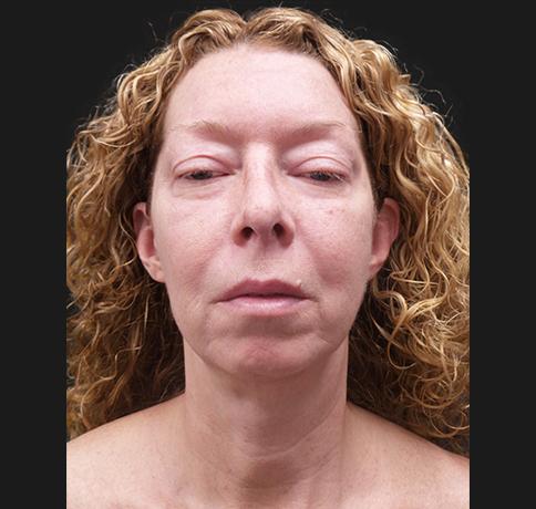 Blepharoplasty before at Aristocrat Plastic Surgery in Scarsdale, NY