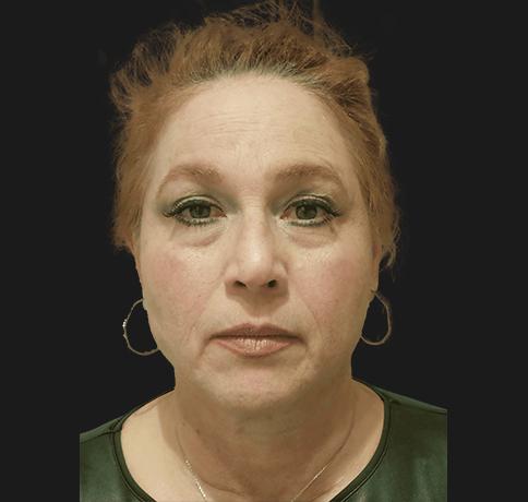 Neck Lift after at Aristocrat Plastic Surgery in Scarsdale, NY