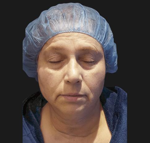 Neck Lift before at Aristocrat Plastic Surgery in Scarsdale, NY