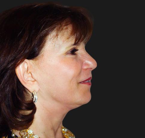 Facelift after at Aristocrat Plastic Surgery in Scarsdale, NY