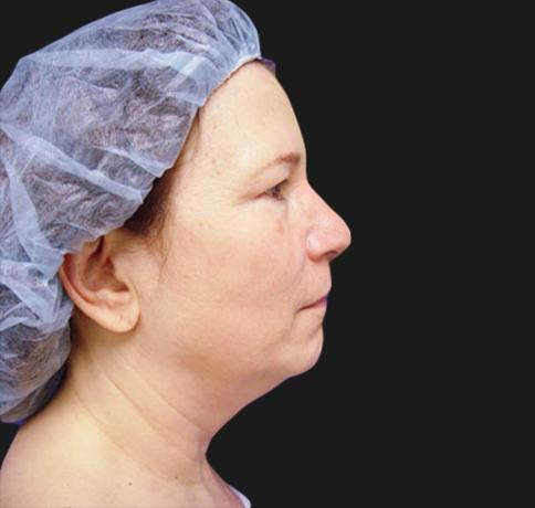 Facelift before at Aristocrat Plastic Surgery in Scarsdale, NY