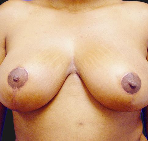Breast Reduction after at Aristocrat Plastic Surgery in Scarsdale, NY