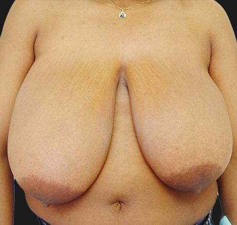 Breast Reduction before at Aristocrat Plastic Surgery in Scarsdale, NY