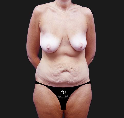 Mommy Makeover before at Aristocrat Plastic Surgery in Scarsdale, NY