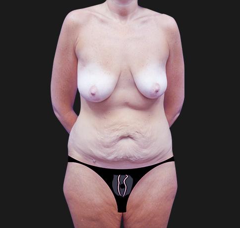 Mommy Makeover before at Aristocrat Plastic Surgery in Scarsdale, NY