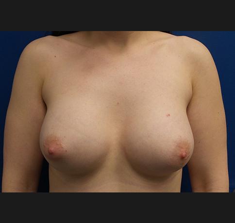 Aristocrat Plastic Surgery breast augmentation after — Scarsdale, NY