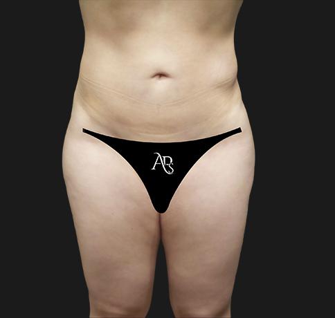 Aristocrat Plastic Surgery liposuction after — Scarsdale, NY