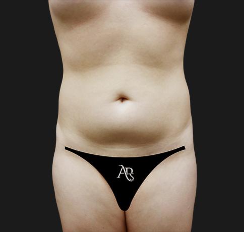 Liposuction before at Aristocrat Plastic Surgery in Scarsdale, NY
