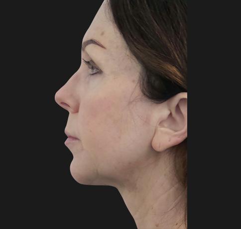 Aristocrat Plastic Surgery neck lift after — Scarsdale, NY