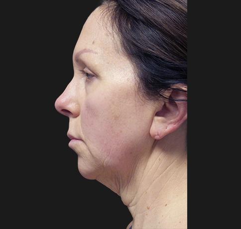Neck Lift before at Aristocrat Plastic Surgery in Scarsdale, NY