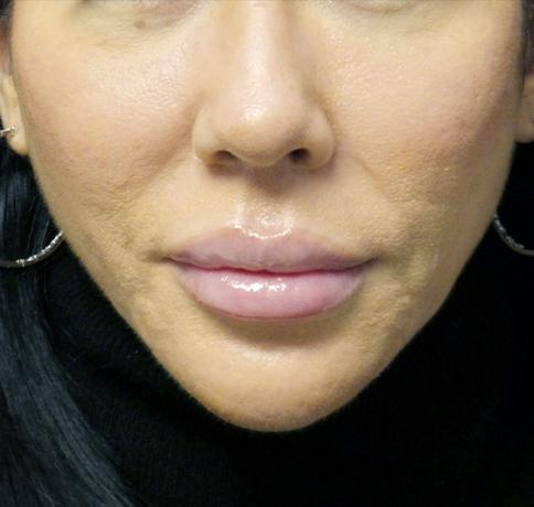 Aristocrat Plastic Surgery chin implant after — Scarsdale, NY