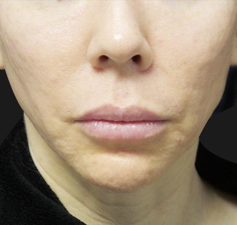 Chin Implant before at Aristocrat Plastic Surgery in Scarsdale, NY