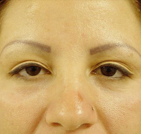 Blepharoplasty after at Aristocrat Plastic Surgery in Scarsdale, NY