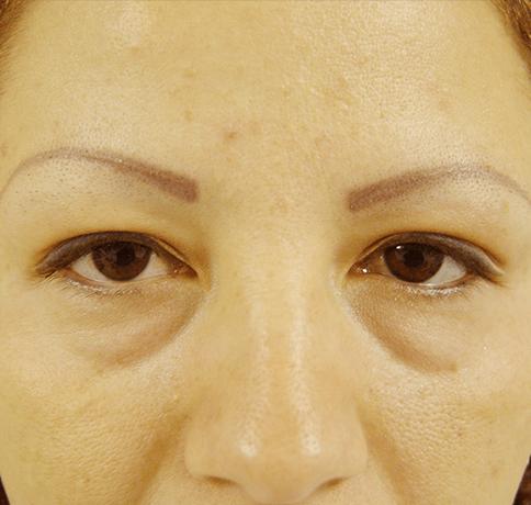 Blepharoplasty before at Aristocrat Plastic Surgery in Scarsdale, NY