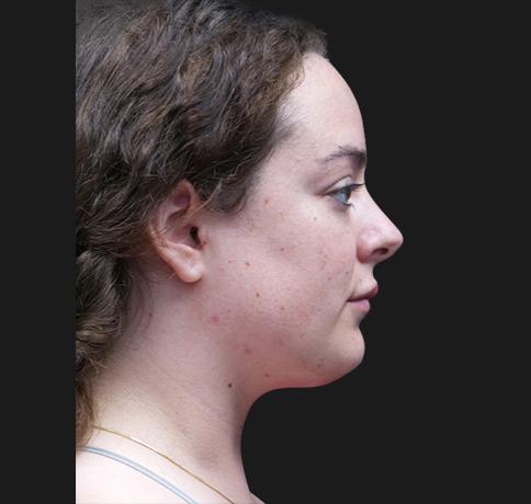 Neck Lift after at Aristocrat Plastic Surgery in Scarsdale, NY
