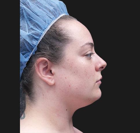 Neck Lift before at Aristocrat Plastic Surgery in Scarsdale, NY