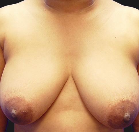 Breast Lift before at Aristocrat Plastic Surgery in Scarsdale, NY
