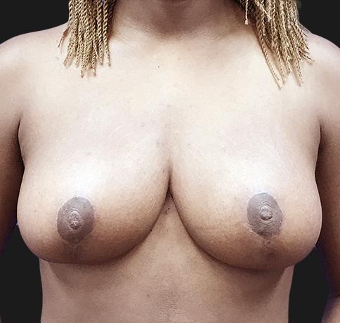 Breast Reduction after at Aristocrat Plastic Surgery in Scarsdale, NY