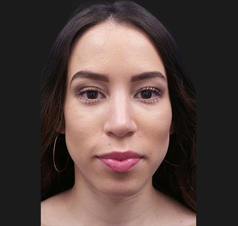 Aristocrat Plastic Surgery rhinoplasty after — Scarsdale, NY