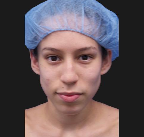 Functional Rhinoplasty before at Aristocrat Plastic Surgery in Scarsdale, NY