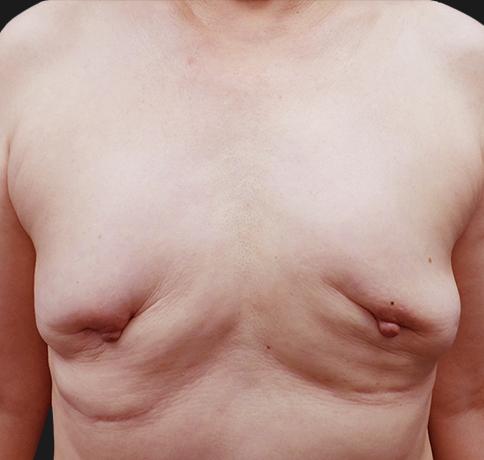 Breast Augmentation before at Aristocrat Plastic Surgery in Scarsdale, NY
